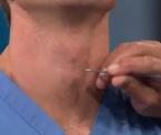 tracheotomy how to