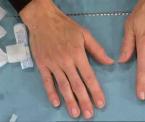 learn about hand rejuvenation surgery