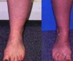 cankle liposuction expained