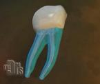 root canal animation