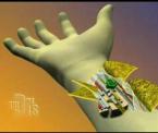 hand transplant animation