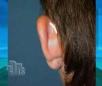 ear pinning otoplasty procedure