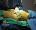 smart lipo surgery