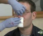 how to treat a bleeding nose