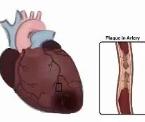 reducing the risk of heart disease