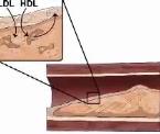 reducing risks of blood clots