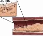 reducing risks of blood clots