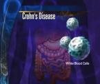 new crohns treatments