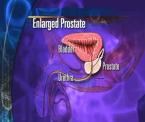 shrinking prostate problems