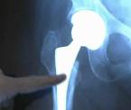 mini hip replacement