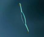 lens implant saves vision