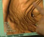 colonoscopy not just for colon cancer