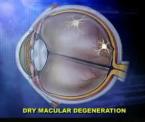 new treatment for macular degeneration