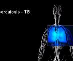 learn about tuberculosis