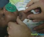 alternatives to tracheostomy in infants