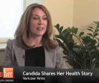 embarrassed of varicose and spider veins candidas story