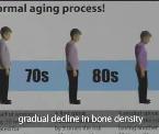 osteoporosis risk factors