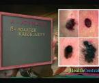 early skin cancer detection with the abcs