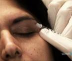 the botox cosmetic treatment