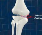 learn about osteoarthritis