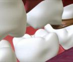 learn about dental cavities