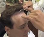 how to get a natural result in a hair transplant