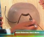 how breast reduction works