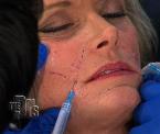 new wrinkle erasing treatment