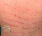 minimizing stretch marks with laser treatment