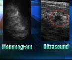 new breast cancer screening ultrasound