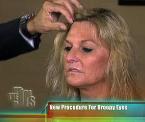 endoscopic brow lift