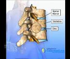 understanding osteoporosis