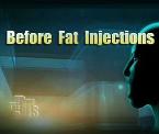 repairing vocal cords with fat injections