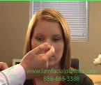 how to tape a nose after rhinoplasty