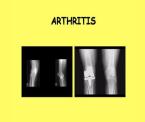 arthritis and sports injuries