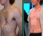 concave chest surgery results
