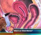 tilted uterus explained