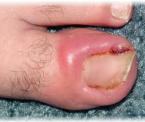 what ingrown toenails are