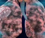 the effects of smoking on your lungs