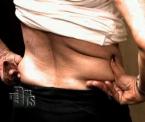 body tite liposuction procedure