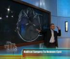 arachnoid cyst surgery results