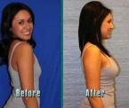 flash recovery breast augmentation results