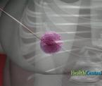 how rice seeds help to treat breast tumors