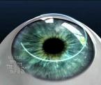 multi focal lasik surgery