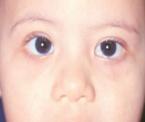 pseudostrabismus eye condition in children