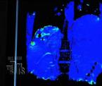 mri guided liver cancer treatment