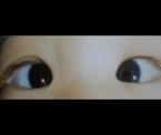 esotropia eye condition in children