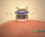 implantable telescope for macular degeneration