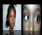 duanes syndrome eye condition in children