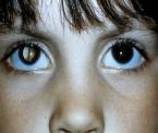 white pupillary reflex in children